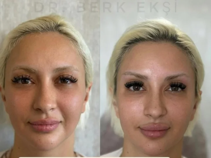 Badem Göz Dolgusu uygulama sonucu – Dr. Berk Ekşi