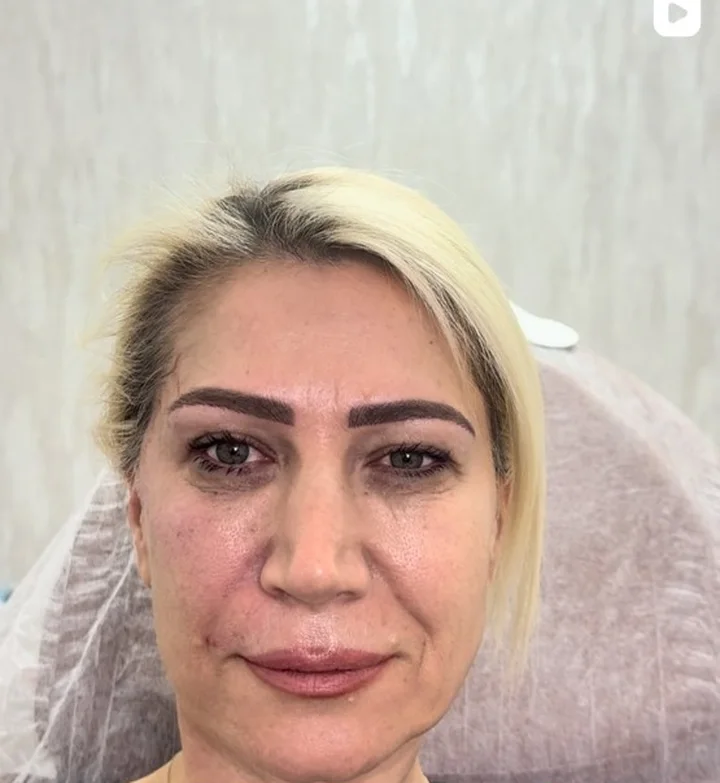 Temporal Lifting uygulama sonucu – Dr. Berk Ekşi