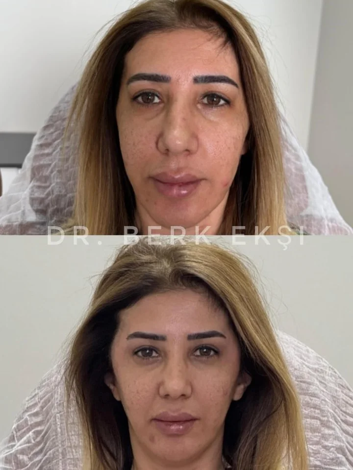 Yüz Gençleştirme uygulama sonucu – Dr. Berk Ekşi