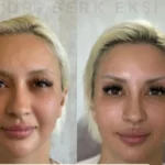 Badem Göz Dolgusu – Dr. Berk Ekşi