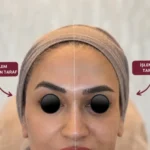 Biyolojik Lifting – Dr. Berk Ekşi
