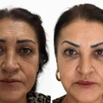 Cilt Gençleştirme – Dr. Berk Ekşi