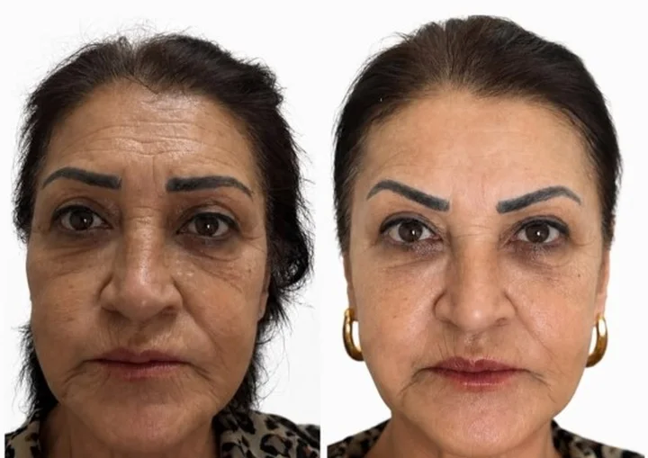 Cilt Gençleştirme – Dr. Berk Ekşi