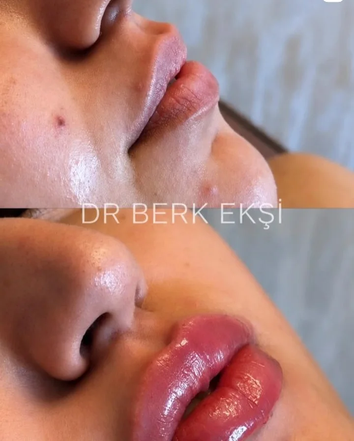 Dudak Dolgusu uygulama örneği – Dr. Berk Ekşi