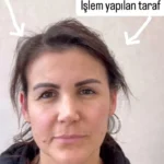 Sıvı Yüz Germe – Dr. Berk Ekşi