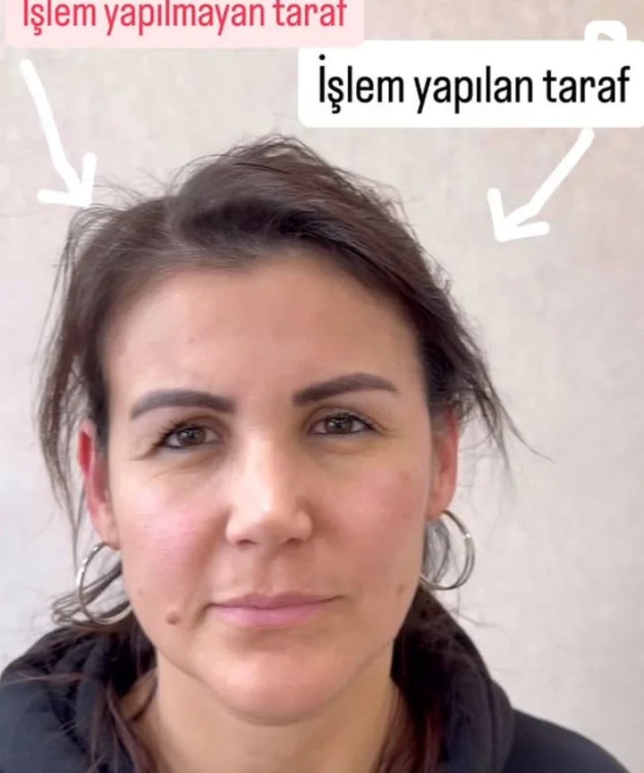 Sıvı Yüz Germe – Dr. Berk Ekşi