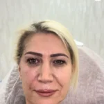 Ameliyatsız Temporal Lifting – Dr. Berk Ekşi
