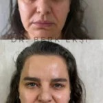 Botoks – Dr. Berk Ekşi